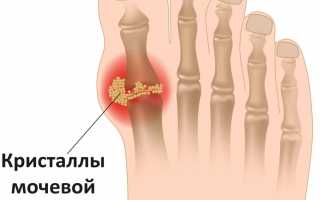 Эффективные способы лечения подагры пищевой содой в домашних условиях