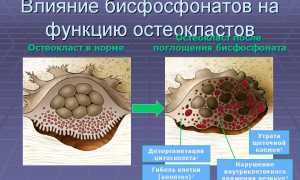Применение препарата Фороза при остеопорозе: эффективность и рекомендации