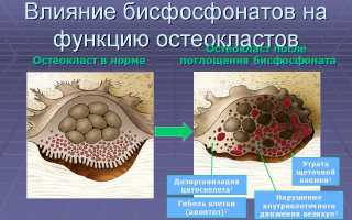 Применение препарата Фороза при остеопорозе: эффективность и рекомендации