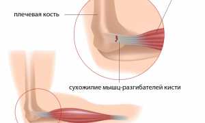 Как проявляется и лечится синдром теннисного локтя? Полное руководство