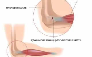 Как проявляется и лечится синдром теннисного локтя? Полное руководство