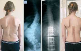 Способы хирургического лечения сколиоза у пациентов