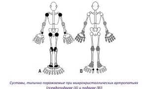 Какие методы диагностики подагры существуют и как они работают?