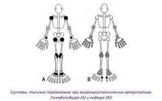 Какие методы диагностики подагры существуют и как они работают?