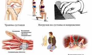 Причины развития сухожильного ганглия и его лечение: важные аспекты