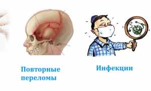 Как лечить фиброзную дисплазию костей черепа? Полезные советы и рекомендации