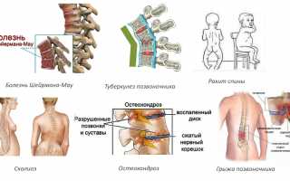 Симптомы и лечение кифоза поясничного отдела позвоночника