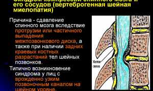 Диагностика и лечение при диагнозе цервикалгия шеи: важные аспекты