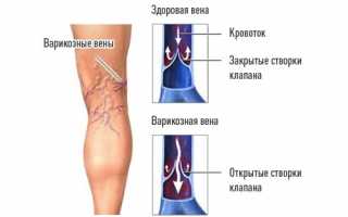 Почему возникают судороги в ногах и как с ними бороться? Полезные советы и рекомендации