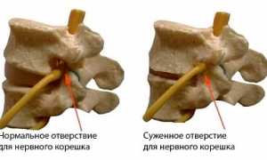 Что такое сакрализация позвонка и какие виды существуют в медицине?