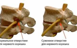 Что такое сакрализация позвонка и какие виды существуют в медицине?