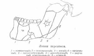 Первая помощь при переломе челюсти и особенности лечения в домашних условиях