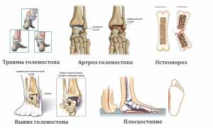 Как проводят рентгенографию голеностопного сустава? Полное руководство