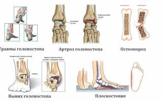 Как проводят рентгенографию голеностопного сустава? Полное руководство