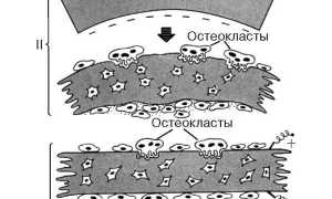 Лечение остеопороза у ребенка: важные аспекты и рекомендации