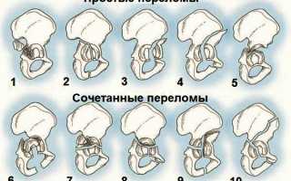 Симптоматика и лечение перелома вертлужной впадины у пациентов
