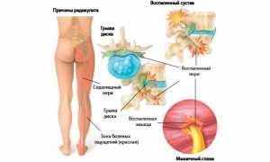 Эффективные свечи от радикулита для облегчения боли