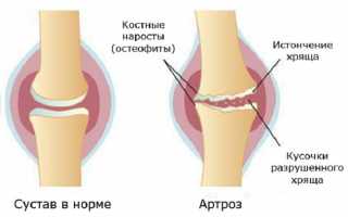 Лечение артроза коленного сустава физиопроцедурами для улучшения состояния