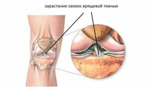 Особенности проявления лигаментоза связок в суставах человека