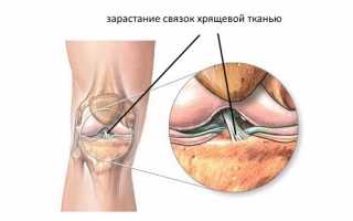 Особенности проявления лигаментоза связок в суставах человека