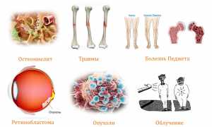 Признаки развития и лечение остеогенной саркомы у пациентов