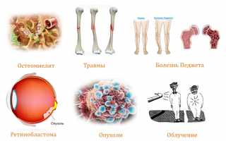 Признаки развития и лечение остеогенной саркомы у пациентов