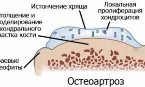 Характерные симптомы полиостеоартроза и его лечение: важные аспекты для понимания