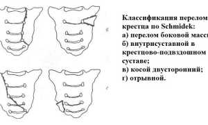 Лечение и реабилитация после перелома крестца: советы и рекомендации
