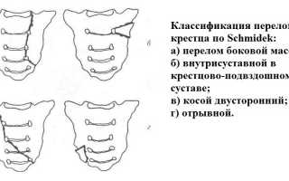 Лечение и реабилитация после перелома крестца: советы и рекомендации