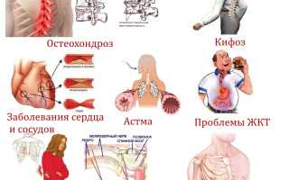 Как снять боли в спине в грудном отделе позвоночника? Полезные советы и рекомендации.