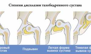 Лечение врожденного вывиха тазобедренного сустава у детей