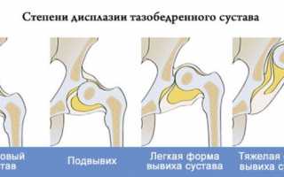 Лечение врожденного вывиха тазобедренного сустава у детей