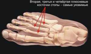 Причины развития болезни Дойчлендера (маршевого перелома) у спортсменов