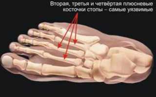 Причины развития болезни Дойчлендера (маршевого перелома) у спортсменов