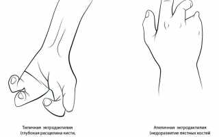 Причины развития эктродактилии и способы ее лечения у пациентов