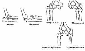 Признаки и особенности лечения вывиха предплечья у взрослых