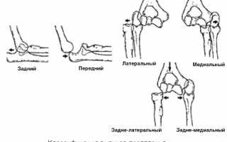 Признаки и особенности лечения вывиха предплечья у взрослых