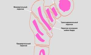 Первая помощь и лечение перелома шейки бедра: советы и рекомендации