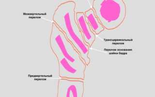 Первая помощь и лечение перелома шейки бедра: советы и рекомендации