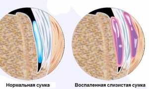 Бурсит: воспаление суставной сумки пальцев и запястья кисти — причины и лечение