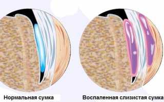 По каким признакам определить бурсит стопы и как его лечить правильно?