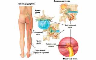 Инъекционная блокада при радикулите: методы и рекомендации