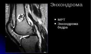 Проявление синдрома Маффуччи и методы его лечения: важные аспекты и рекомендации