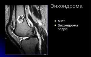 Проявление синдрома Маффуччи и методы его лечения: важные аспекты и рекомендации