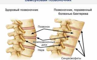 По каким анализам диагностируют болезнь Бехтерева? Узнайте подробности