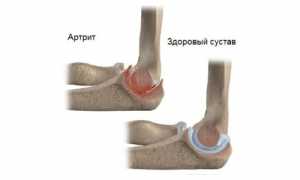 Почему возникает боль в локте при надавливании? Причины и советы