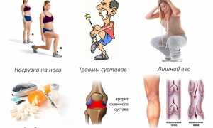Методы лечения артроза большого и других пальцев ноги: советы и рекомендации