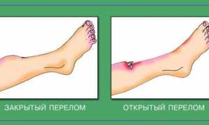 Можно ли после перелома посещать баню или сауну для восстановления здоровья?