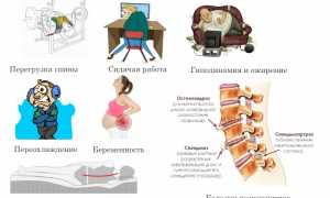 Чем грозит защемление нерва в позвоночнике? Узнайте важные последствия