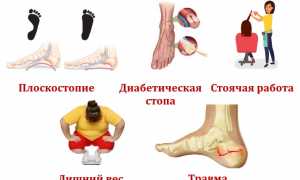 Признаки развития кисты пяточной кости и ее лечение: важные аспекты